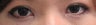 Bilateral Asian Eyelid Surgery