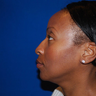 Chin Augmentation 