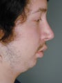 Male Chin Implant 