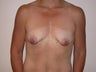 Breast Lift
