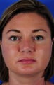 Revision Rhinoplasty