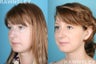 Rhinoplasty