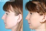 Rhinoplasty