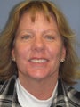 Brow Lift on 53-year-old