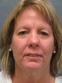 Brow Lift on 53-year-old