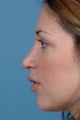 Rhinoplasty