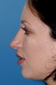Rhinoplasty