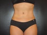 Hi-definition sculplting with Smartlipo and  "PRO-Sculpt" Formula