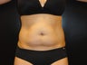 Hi-definition sculplting with Smartlipo and  "PRO-Sculpt" Formula