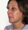 Neck and Face Lift