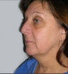 Neck and Face Lift