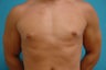 26 year old man with gynecomastia 