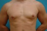 26 year old man with gynecomastia 