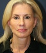 Facelift (Comprehensive Rejuvenation Procedures)