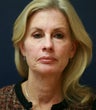 Facelift (Comprehensive Rejuvenation Procedures)
