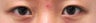 Bilateral Asian Eyelid Surgery 