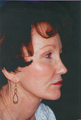 Laser Skin Resurfacing