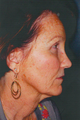 Laser Skin Resurfacing