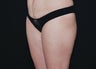 Liposuction