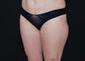Liposuction