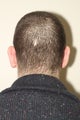 Ear Lobe Surgery