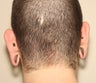 Ear Lobe Surgery