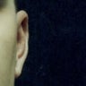 Otoplasty 