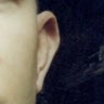 Otoplasty 