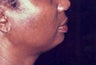 Chin Augmentation