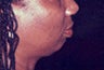Chin Augmentation