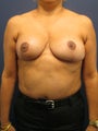 Breast Lift