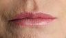 60 year old Female lips treated with Juvederm and Botox