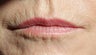 60 year old Female lips treated with Juvederm and Botox