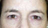 Laser Eye Lid Lift (Laser Blepharoplasty)