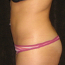 Liposuction 