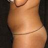 Liposuction 
