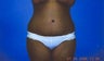 Tummy Tuck