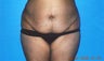Tummy Tuck