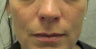 Restylane
