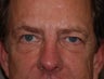 Juvederm to Tear Troughs (lower lids)