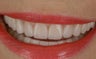 Gum lift treatment for gummy smile