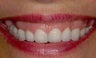 Gum lift treatment for gummy smile