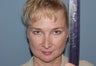 Patient requesting  correction for sub-optimal results after esthetic nasal surgery