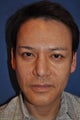 56 Year Old Male Undergoes Facelift, Brow Lift, Upper Eyelid Lift