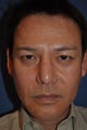 56 Year Old Male Undergoes Facelift, Brow Lift, Upper Eyelid Lift