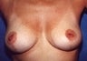 Female patient who underwent a breast augmentation for inverted nipples 