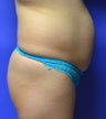 42 year old Female treated for lack of Gluteal Volume