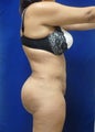Brazilian Butt lift