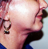 Chin Implant