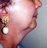 Chin Implant